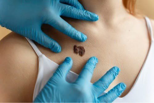 keloid scar treatment options