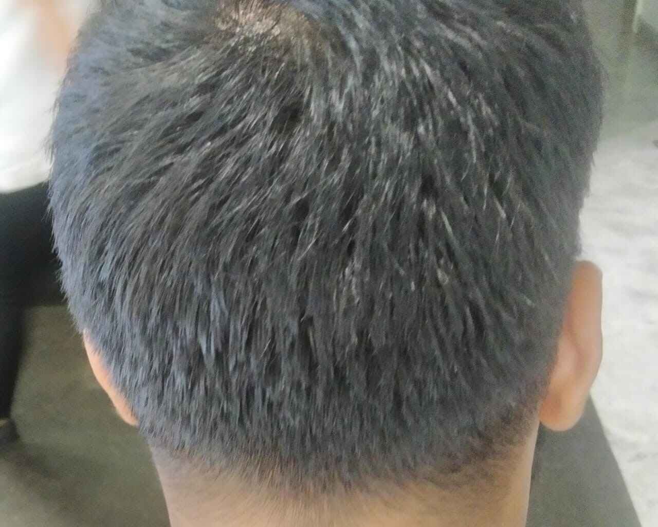 Most Trusted Hair Transplant Clinic in Bangalore