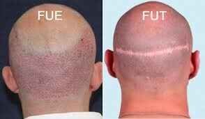 Most Trusted Hair Transplant Clinic in Bangalore