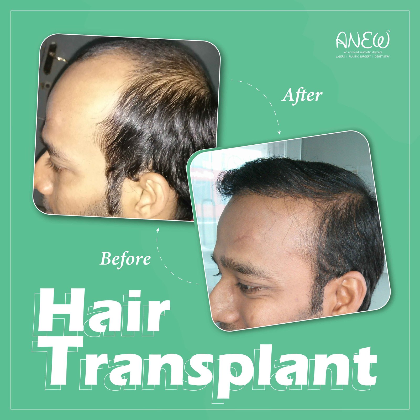 Most Trusted Hair Transplant Clinic in Bangalore