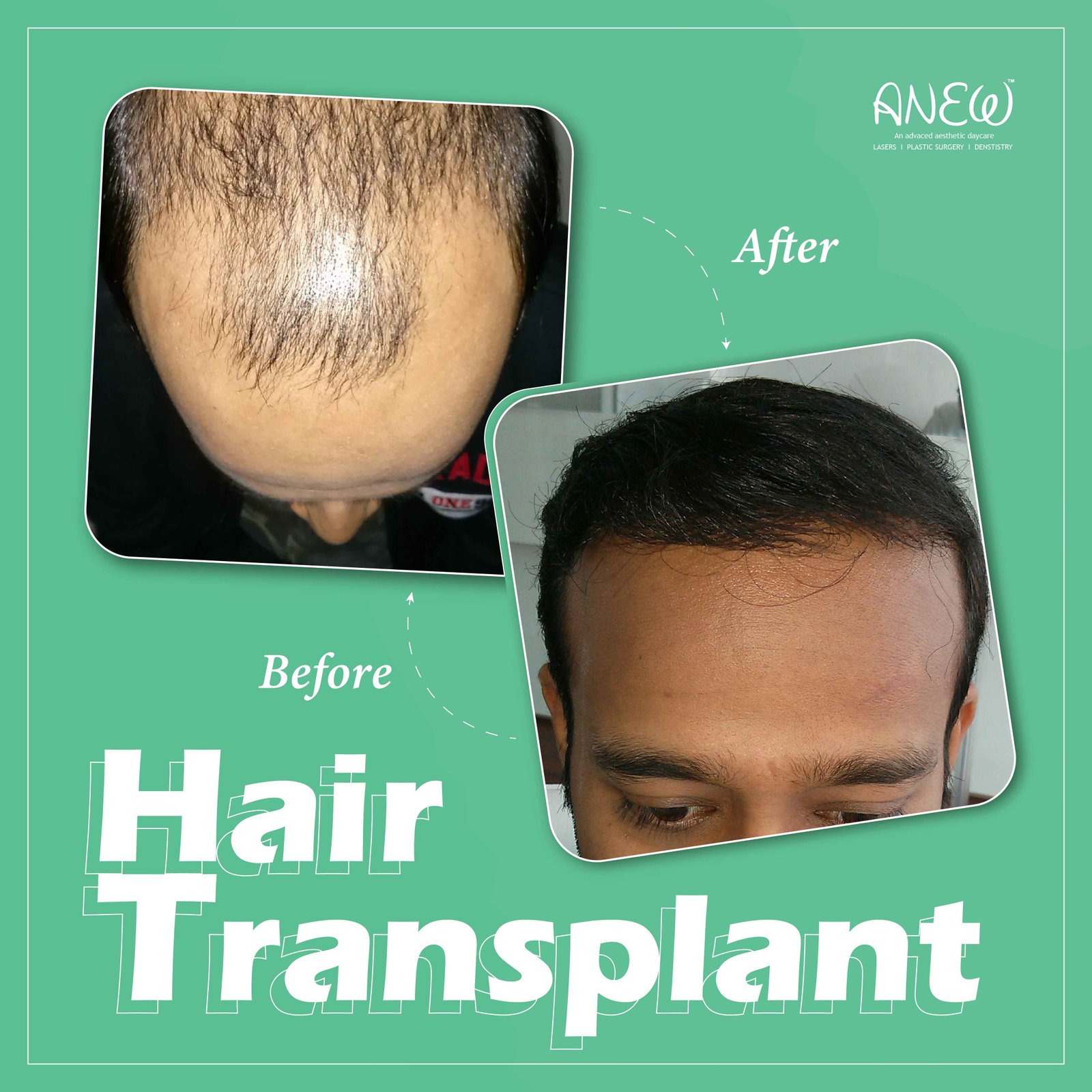 Most Trusted Hair Transplant Clinic in Bangalore