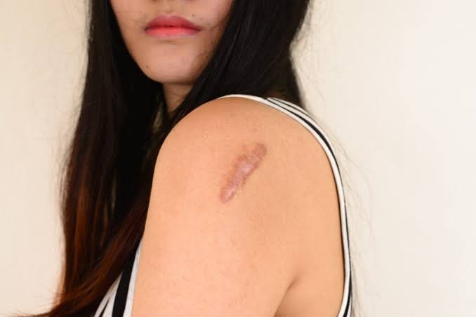 Best Treatment for Keloid in Bangalore: Expert Insight from Anew Cosmetic Clinic