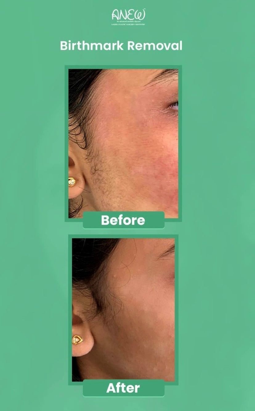 Best Laser Birth Mark Removal Treatment in Bangalore