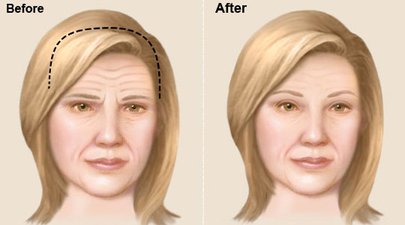 Brow Llift Surgery in Banashankari Bangalore