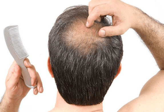 Causes of Hair Loss in Men