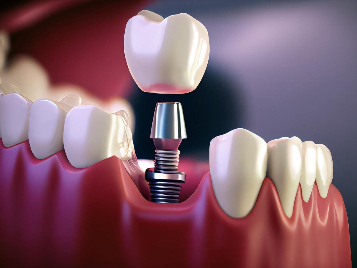 Dental Implant with Same-Day Crown Fixing: Transform Your Smile in Just One Visit