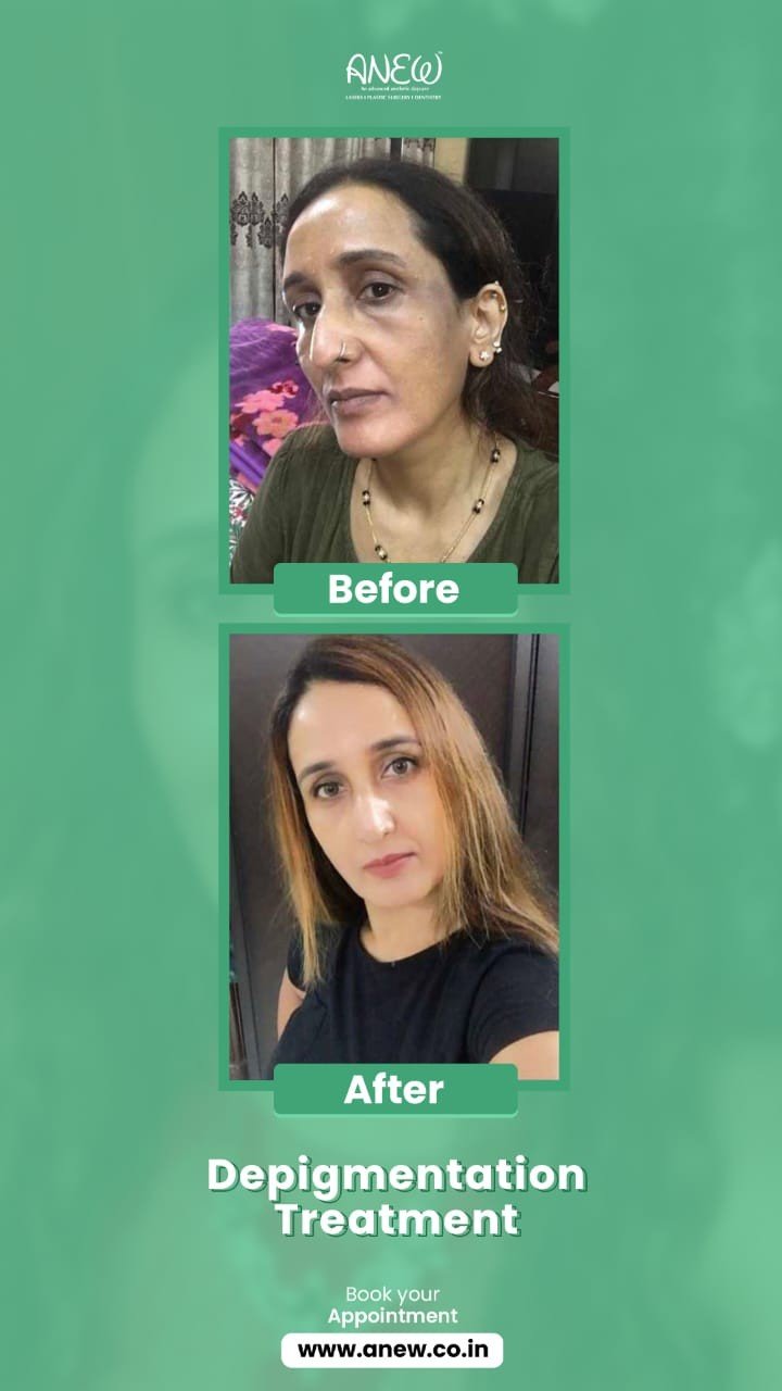 Best Pigmentation, Skin Brightening Treatment in Bangalore