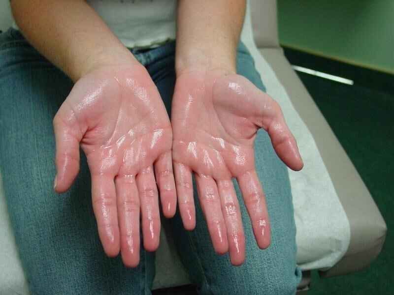 Embracing Confidence: Understanding and Managing Summer and Palmar Hyperhidrosis