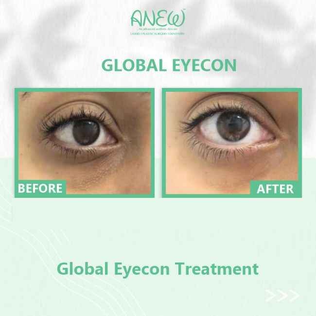 Global Eyecon Treatment