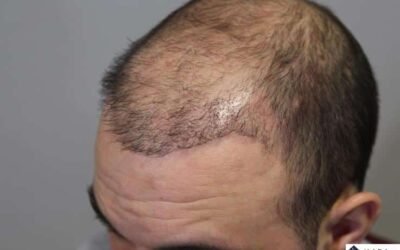 Hair Transplant Gone Wrong? Expert Advice from Anew Cosmetic Clinic