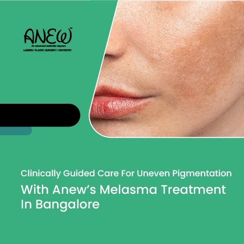 Best Melasma Treatment In Bangalore