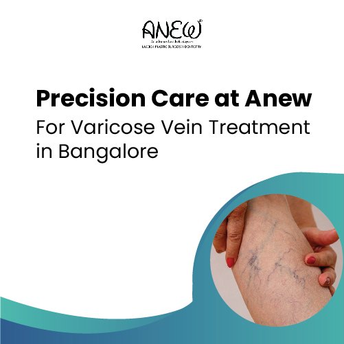 Varicose Veins Treatment in Bangalore I Cost & Results