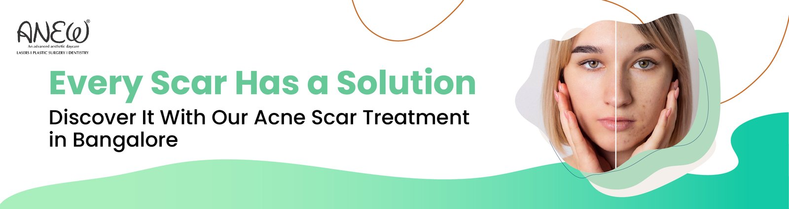 acne scar treatment in bangalore