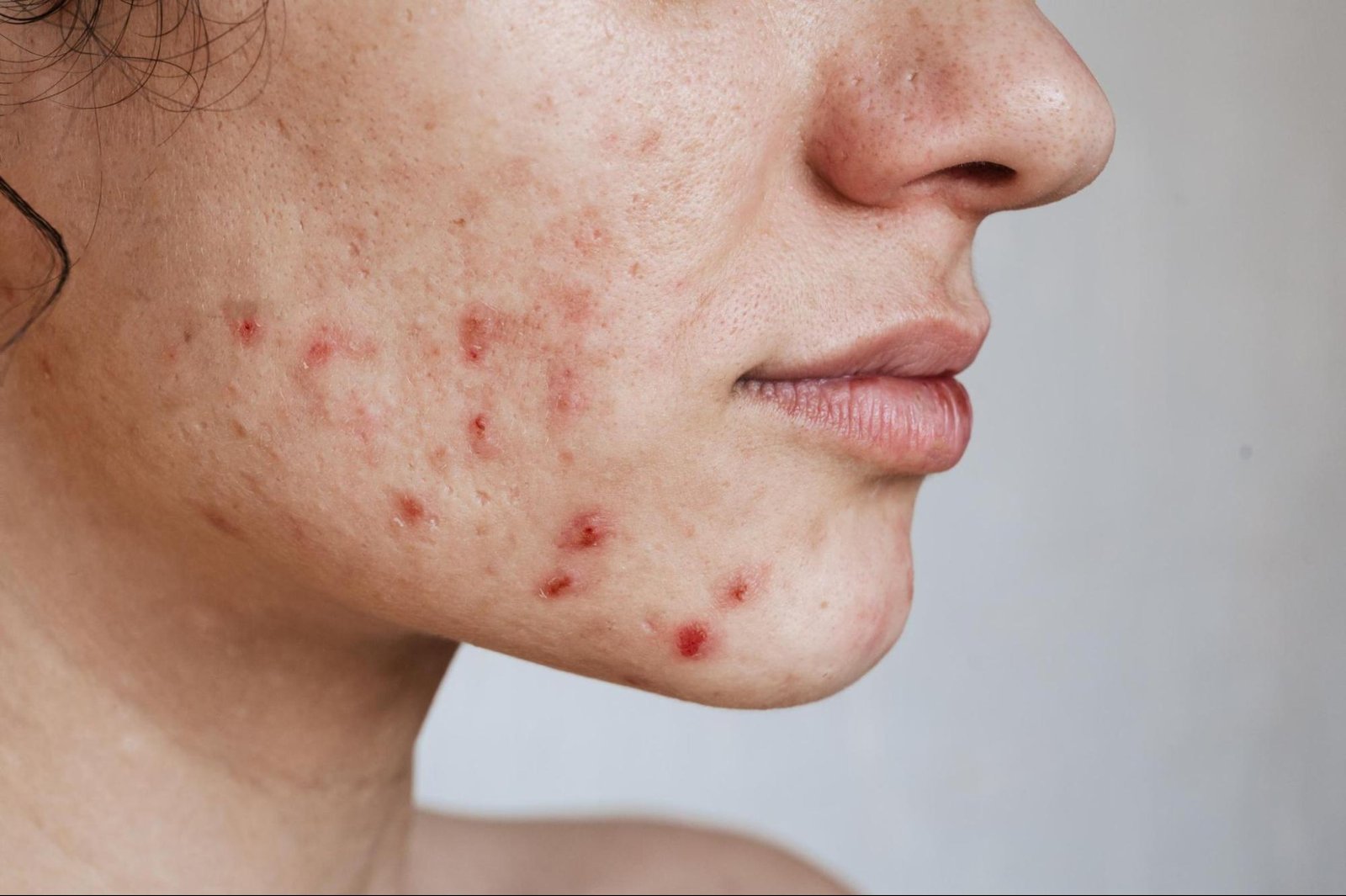 are acne scars really permanent​