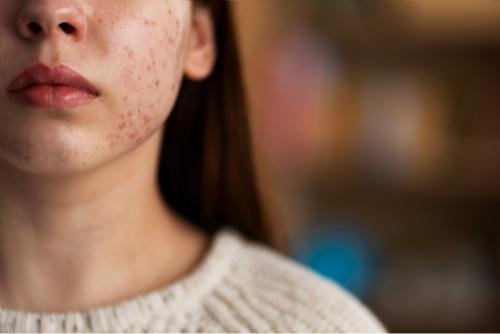 acne scars permanent or not​
