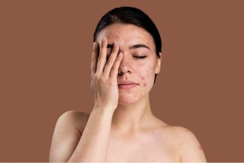 Are Acne Scars Permanent? Hear From Experts