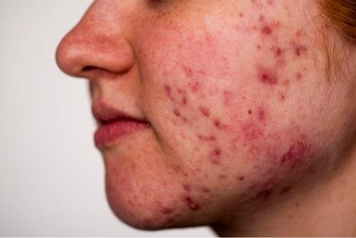 acne scars are permanent or not​