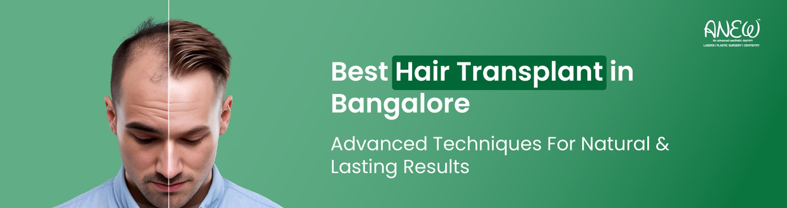 Hair transplant in bangalore 