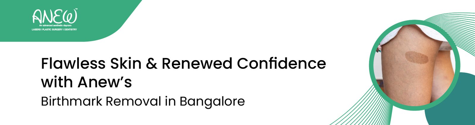 Best Birth mark removal treatment in Bangalore