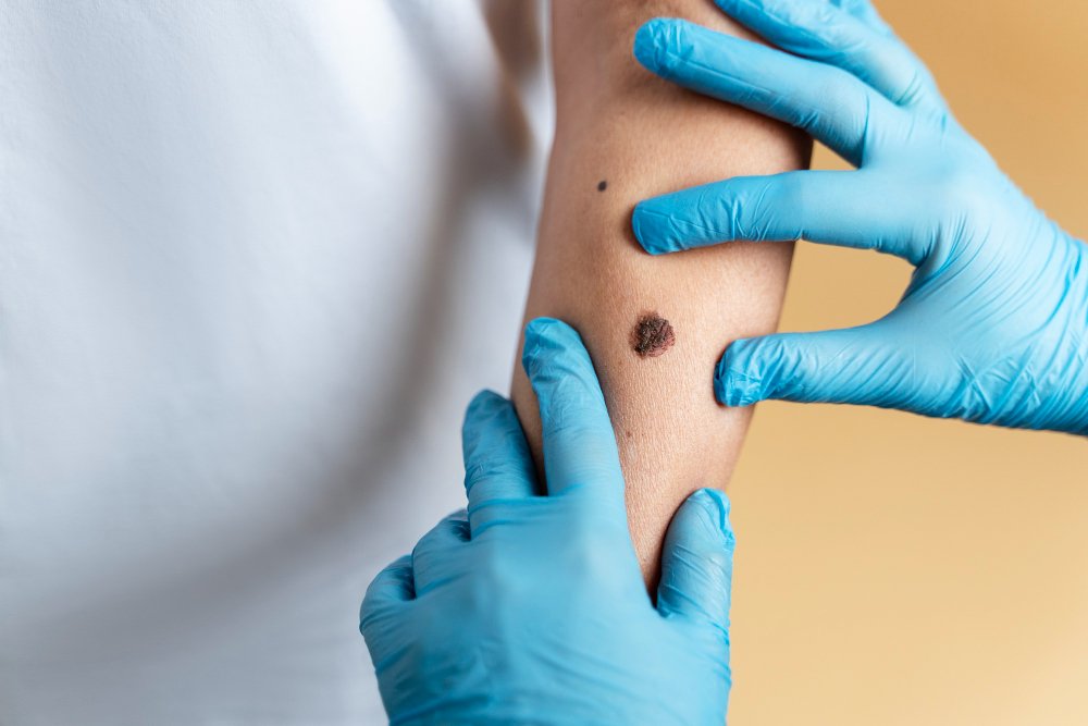 birthmark removal treatments