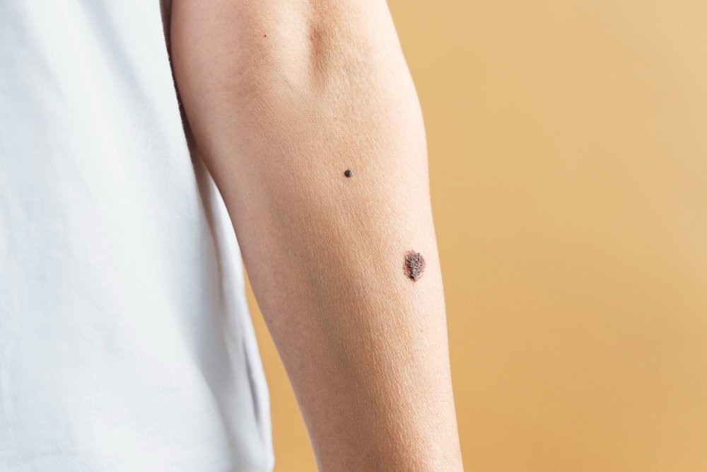 birthmark removal treatments