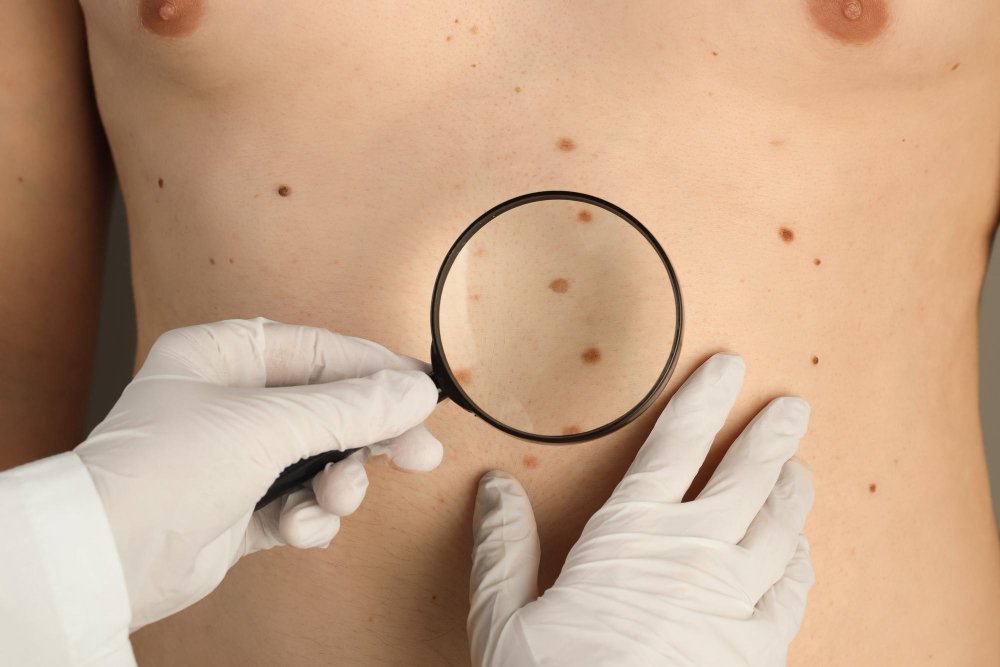 permanent birthmark removal