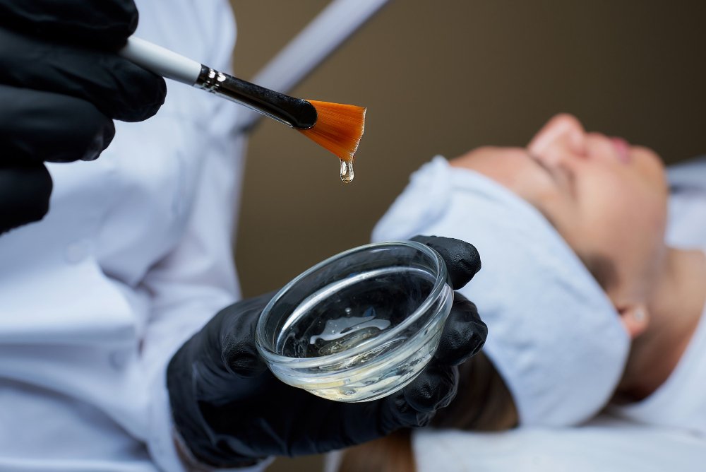 chemical peel for skin
