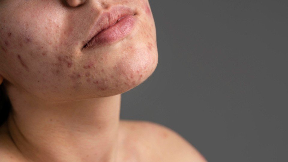 does hyperpigmentation go away