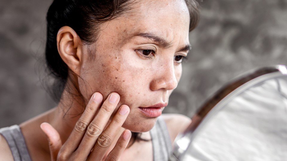 Hyperpigmentation treatment