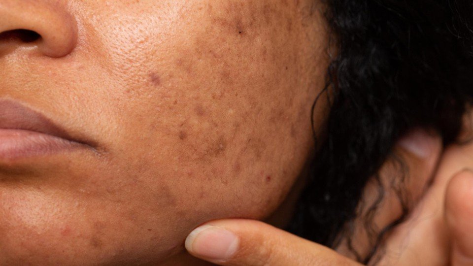 What is hyperpigmentation?