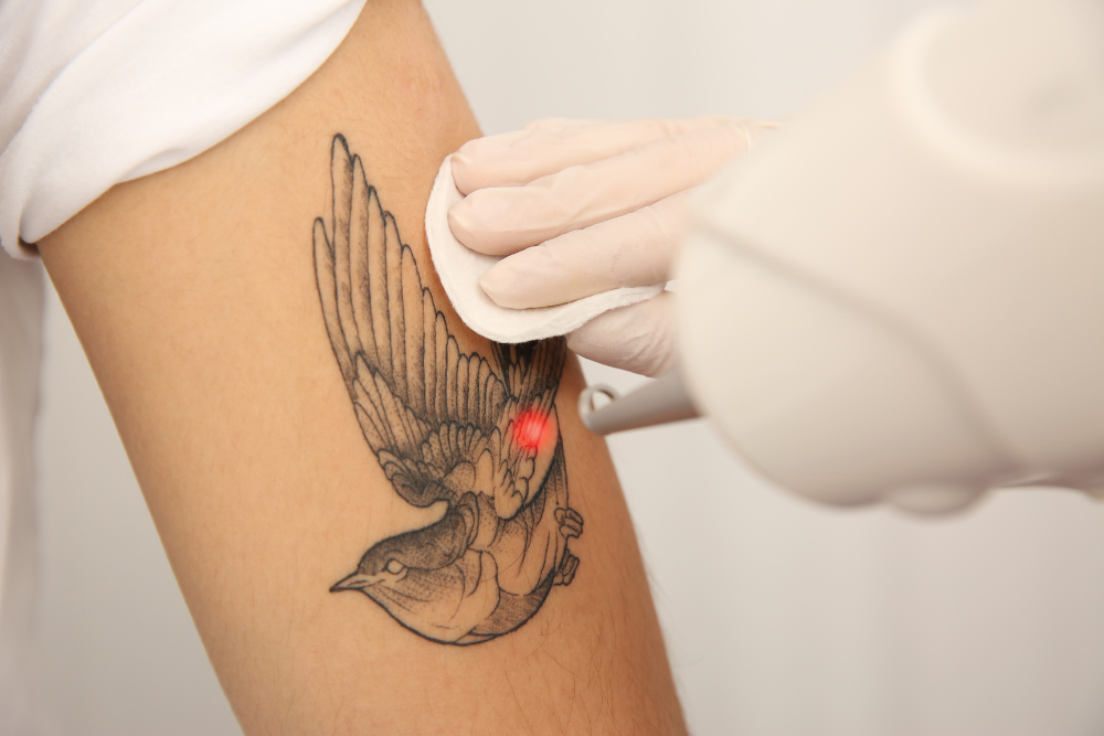 is laser tattoo removal safe
