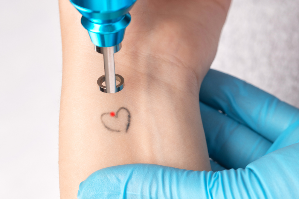 Laser tattoo removal after care