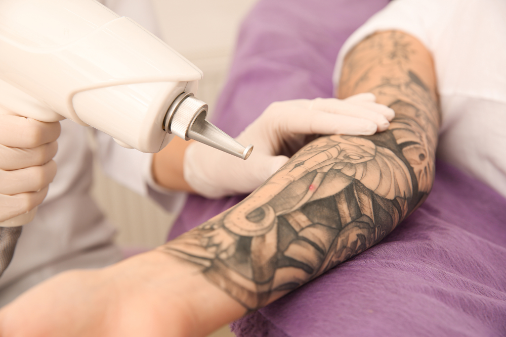 Laser tattoo removal process