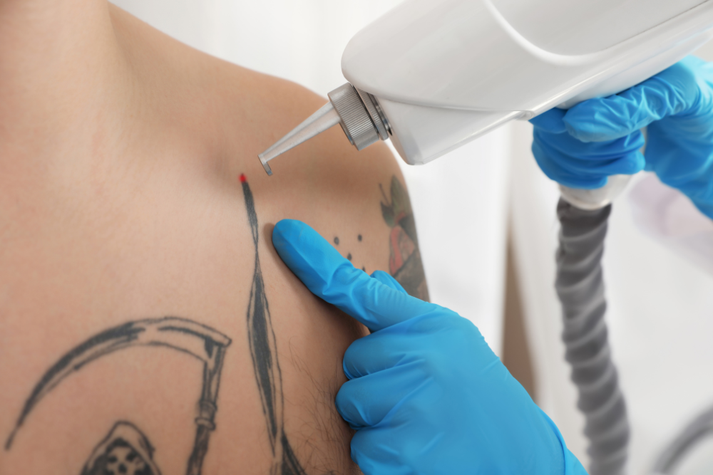 is laser tattoo removal safe