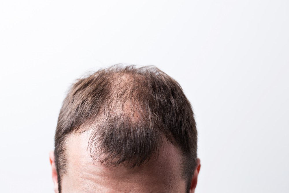 male pattern baldness treatment