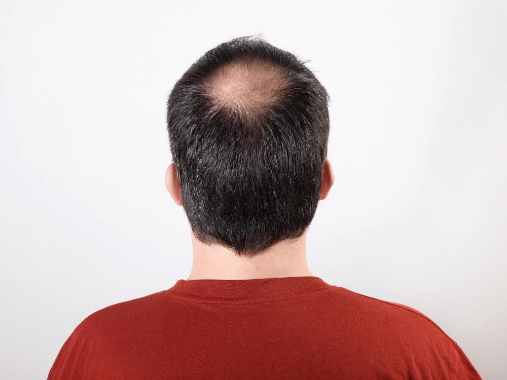 male pattern baldness treatment
