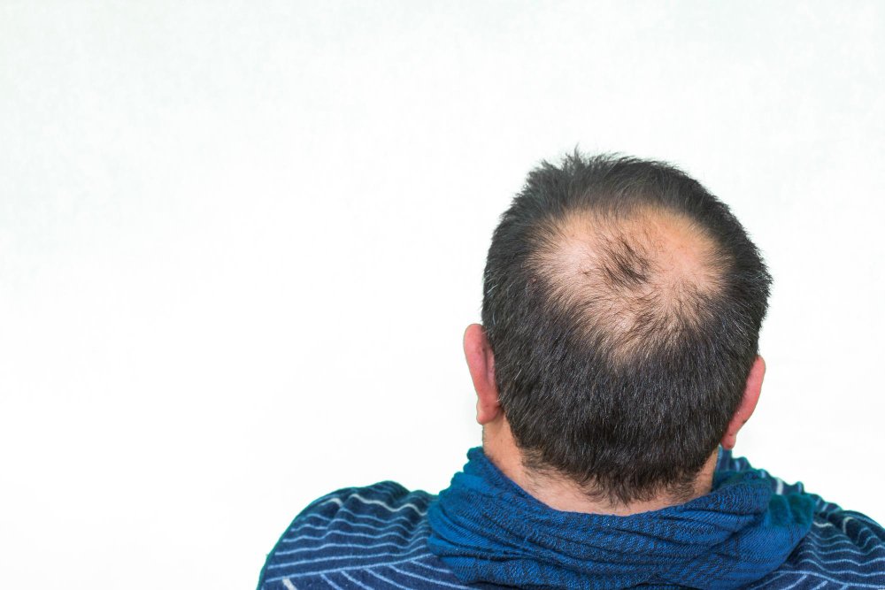 male pattern baldness treatment