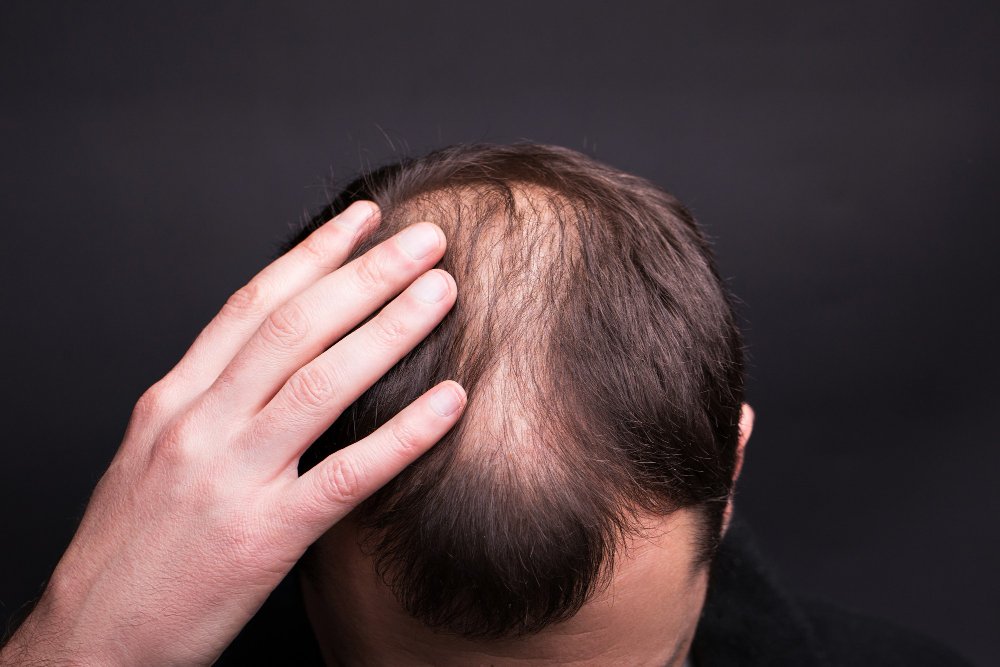 male pattern baldness treatment