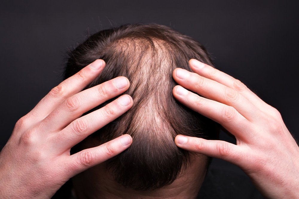 prp hair treatment