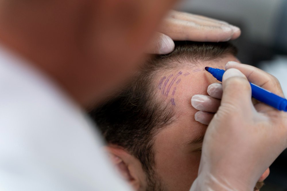 chemical peel for skin