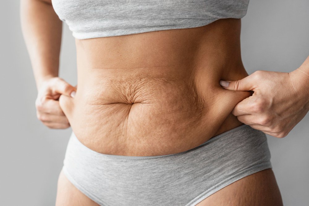 How to Get Rid of Stretch Marks Permanently