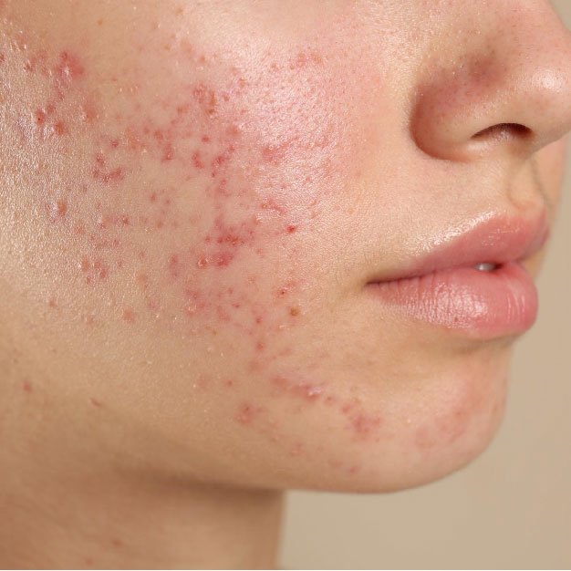 chemical peel in bangalore