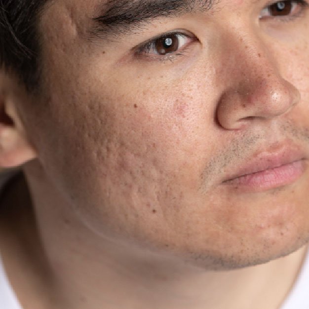 best chemical peel in bangalore