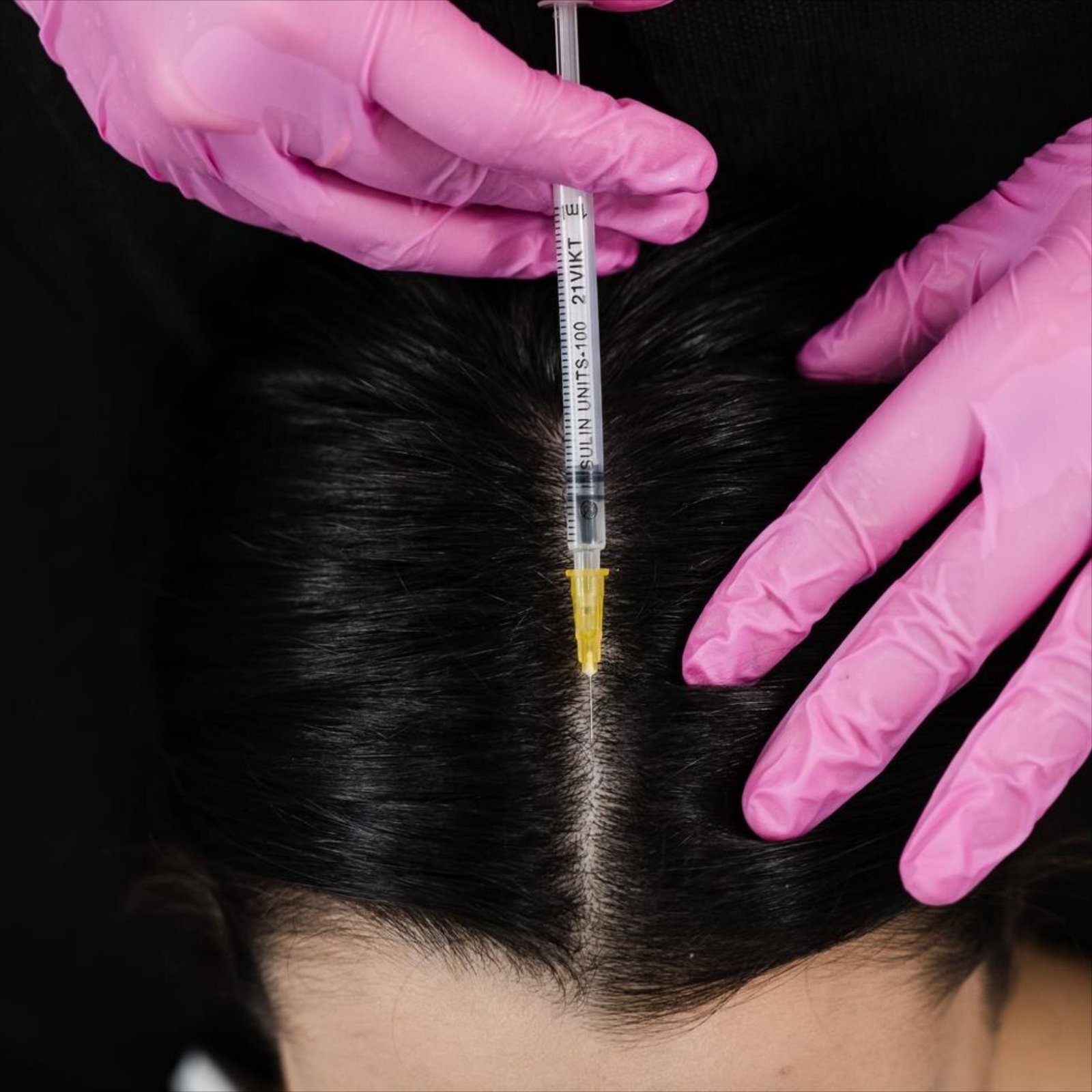 Mesotherapy for Hair 