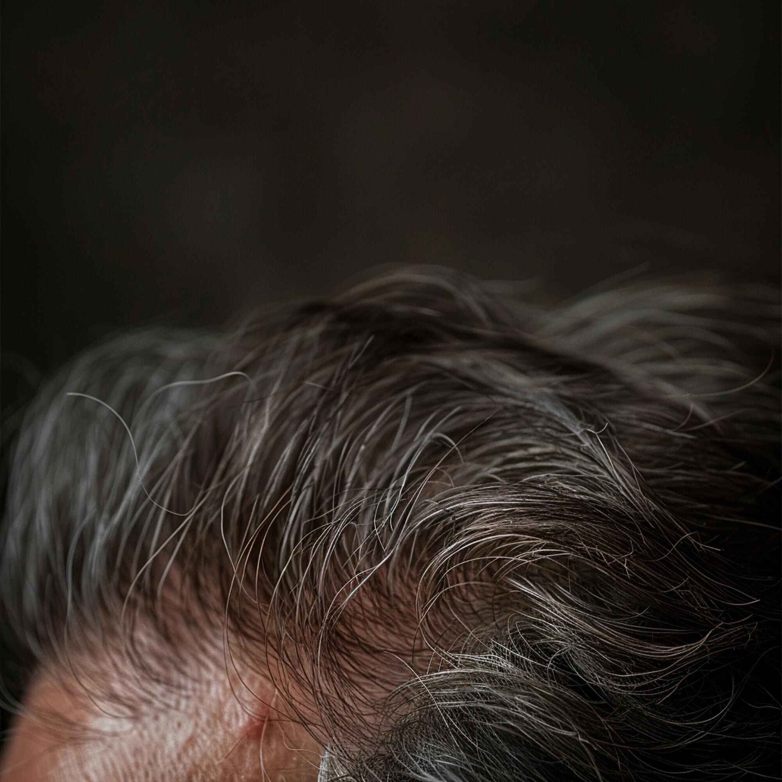 Traction Alopecia