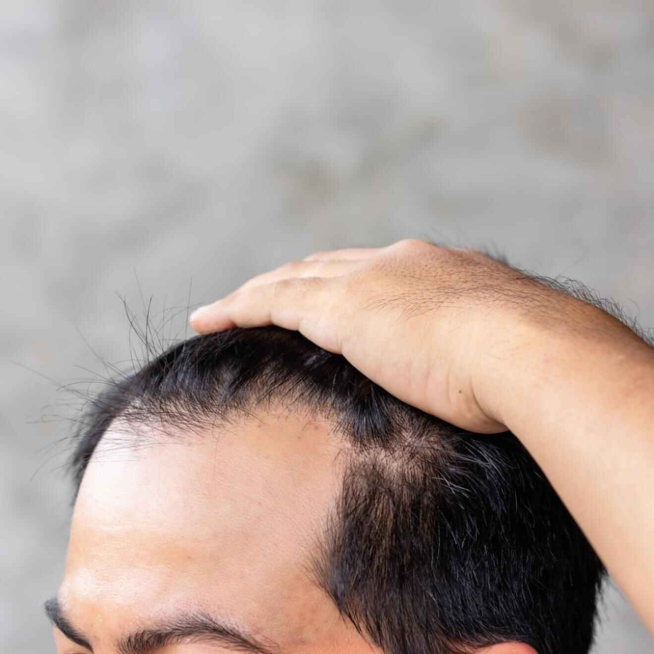 Best Hair Loss Treatment In Bangalore