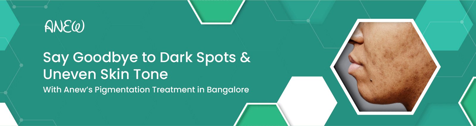 Pigmentation Treatment In Bangalore