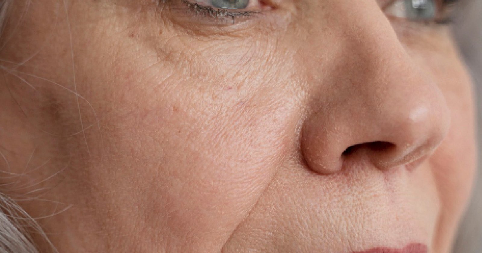 Skin Pigmentation Treatment In Bangalore