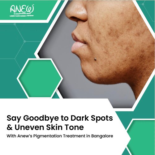 Pigmentation Treatment In Bangalore
