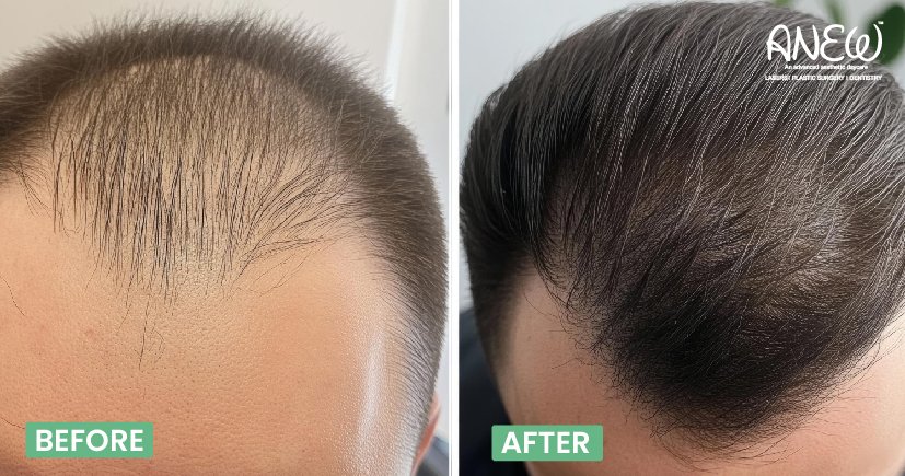 PRP treatment in bangalore 